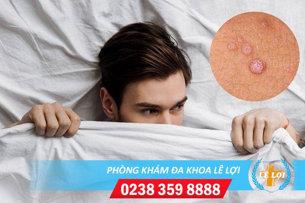 Cách điều trị mụn cơm sinh dục hiệu quả