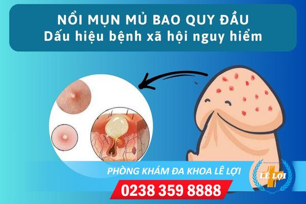 Nổi mụn mủ bao quy đầu phải làm sao?