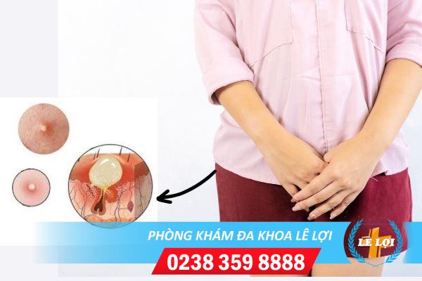 Cách trị mụn vùng kín hiệu quả an toàn
