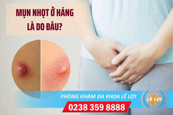 Mụn nhọt ở háng điều trị thế nào?