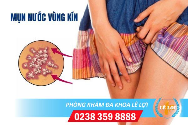 Mụn nước vùng kín điều trị ở đâu hiệu quả?