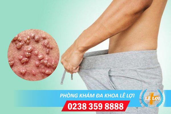 Nổi hạt trắng sinh dục là bị gì nguyên nhân và cách chữa