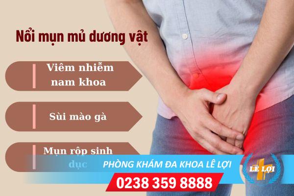 Cách điều trị nổi mụn mủ dương vật hiệu quả