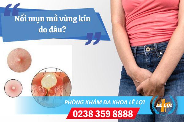 Nguyên nhân nổi mụn mủ vùng kín và cách điều trị