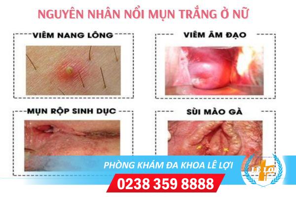 Nổi mụn trắng ở nữ nguyên nhân và cách xử lý