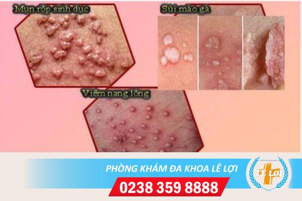 Nổi mụn trắng ở vùng kín nguyên nhân và cách điều trị