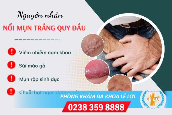 noi-mun-trang-quy-dau-la-bieu-hien-benh-gi-1