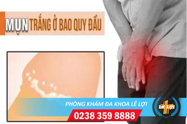 Nổi mụn trắng quy đầu là biểu hiện bệnh gì?