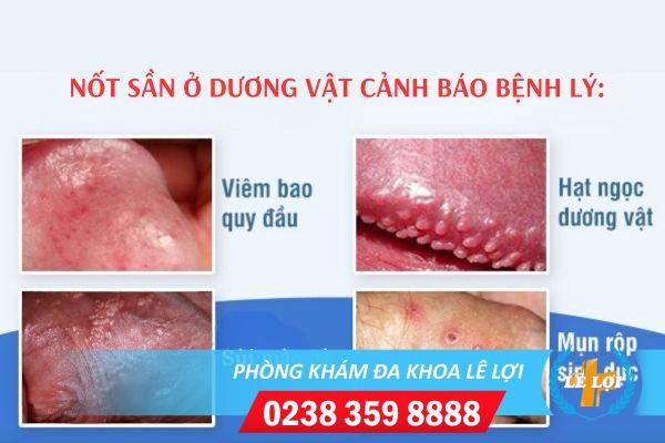 not-san-o-duong-vat-nguyen-nhan-va-cach-dieu-tri-hieu-qua-1