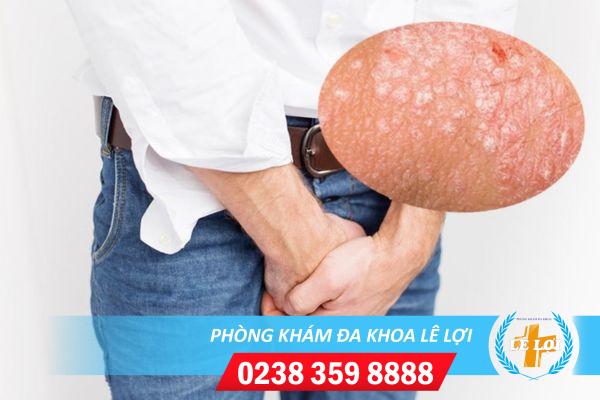 Nốt sần ở dương vật nguyên nhân và cách điều trị hiệu quả