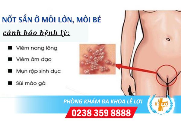 Nốt sần ở môi bé và lớn là bệnh gì?
