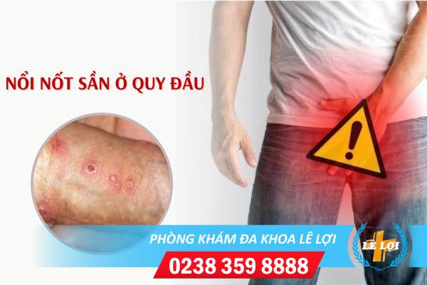 Nốt sần ở quy đầu: Nguyên nhân và cách xử lý