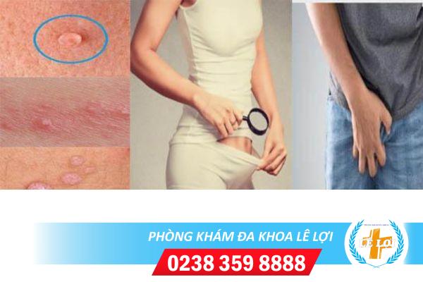 Nốt sần ở vùng kín là bệnh gì nguy hiểm không?