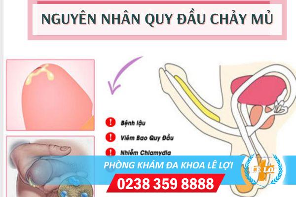 quy-dau-chay-mu-dieu-tri-the-nao-1