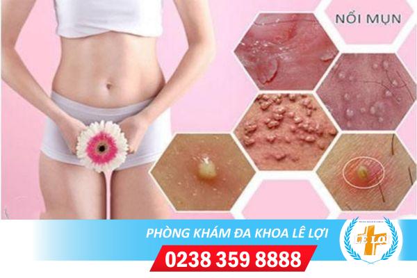 Tại sao bị nổi mụn ở cửa mình giải pháp điều trị