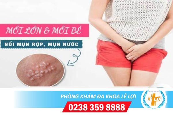 Tại sao nổi mụn nước ở môi lớn và bé?