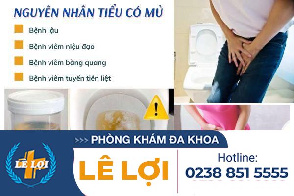 Tiểu có mủ là bị bệnh gì nguy hiểm không?