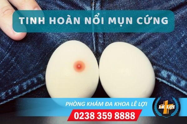 Nguyên nhân và cách chữa tinh hoàn nổi mụn cứng