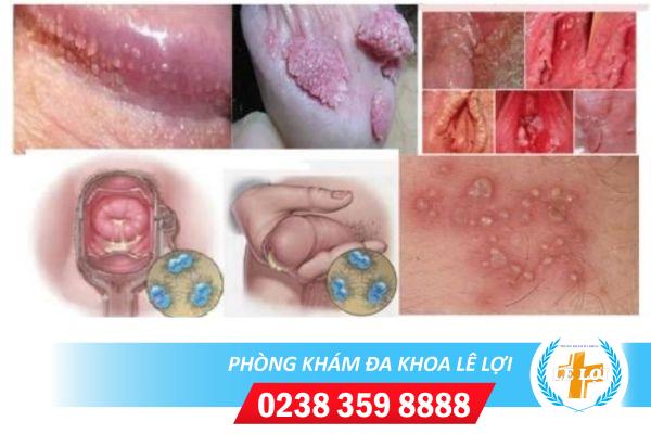 Top những bệnh đường sinh dục nguy hiểm nhất hiện nay