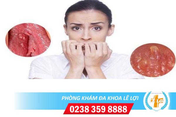 Triệu chứng gai sinh dục ở nữ và cách điều trị