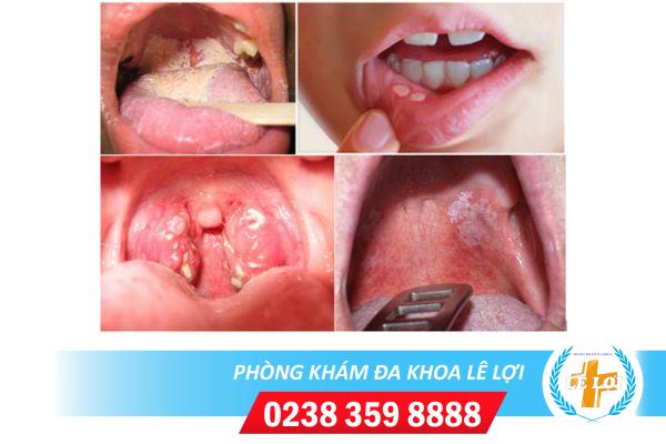 Nguyên nhân lậu ở miệng và dấu hiệu dễ nhận biết