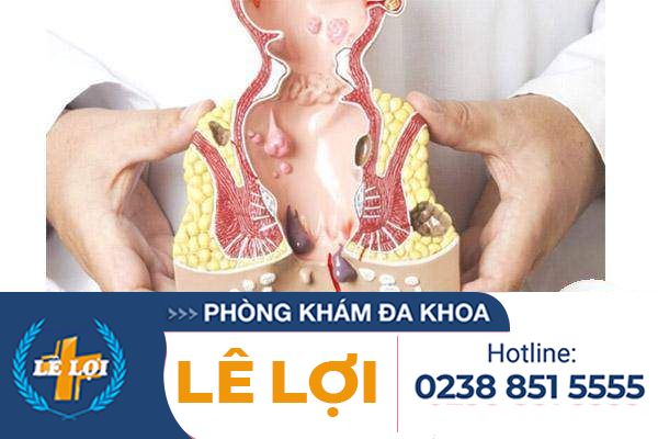 Bị lòi trĩ phải làm sao? cách điều trị hiệu quả