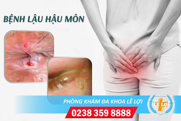 Triệu chứng bệnh lậu ở hậu môn