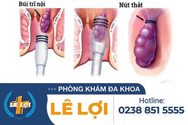 Thắt búi trĩ có hiệu quả và an toàn không?