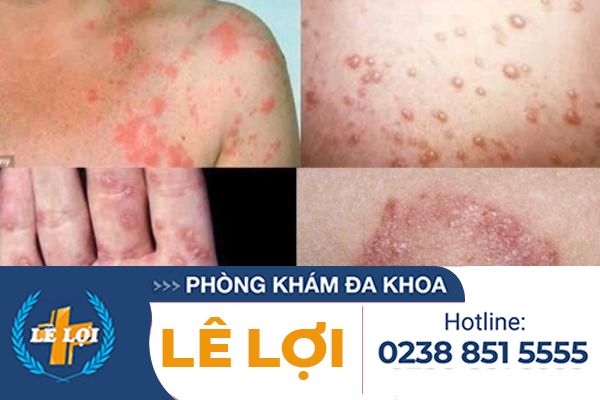 Bệnh lậu cầu có biểu hiện gì và cách điều trị