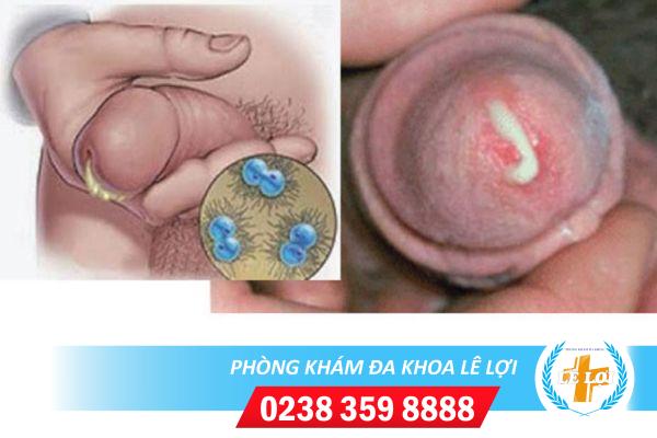 benh-lau-duong-vat-1