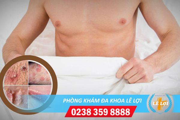 Mụn rộp dương vật: Tác hại và cách chữa hiệu quả