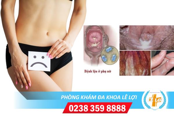 Âm đạo chảy mủ là mắc bệnh gì?
