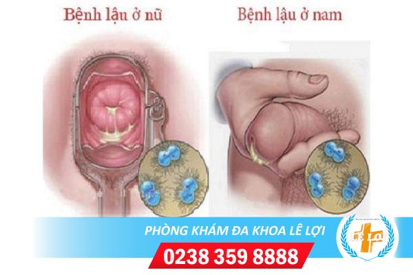 Vùng kín chảy dịch là dấu hiệu bệnh gì?