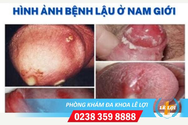 benh-lau-nam (1)