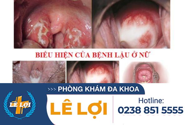 benh-lau-o-nu-gioi-dau-hieu