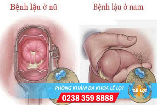 benh-lau