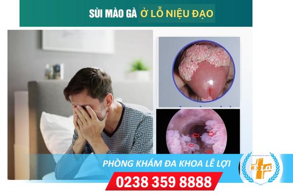 Sùi mào gà lỗ niệu đạo nguy hiểm không điều trị ra sao?