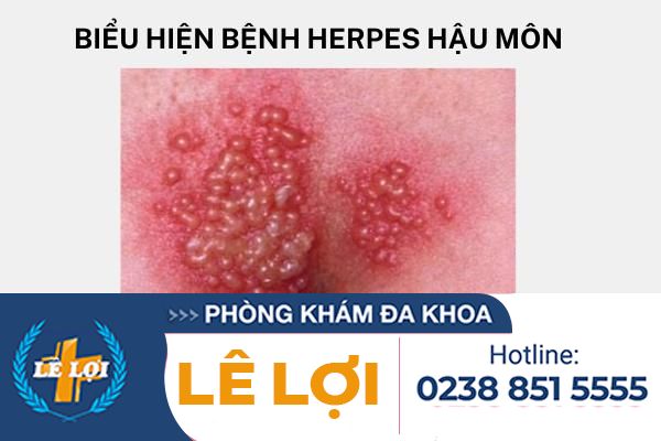 bieu-hien-herpes-hau-mon