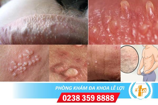 Mụn cóc ở chim phải làm sao?