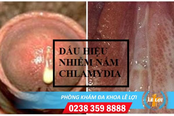Chlamydia