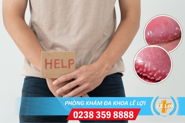 Dấu hiệu bệnh chuỗi hạt ngọc dương vật và cách chữa trị