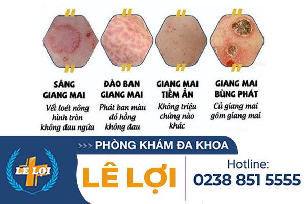dau-hieu-giang-mai-can-di-xet-nghiem