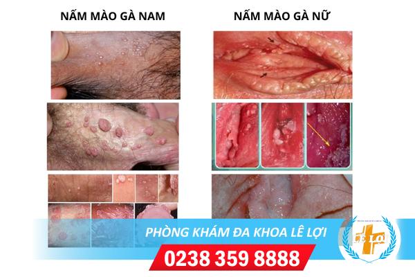 Nấm mào gà là bệnh gì dấu hiệu và cách điều trị