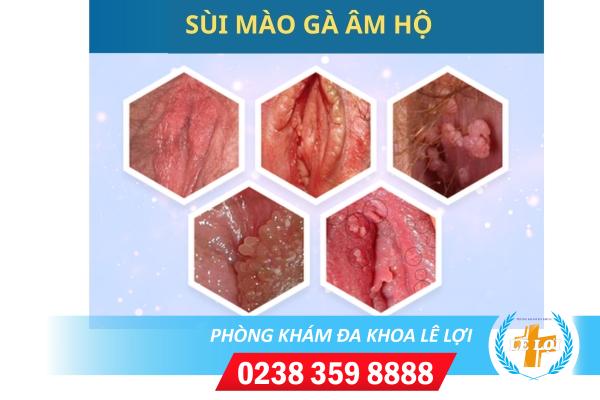 dau-hieu-sui-mao-ga-am-ho