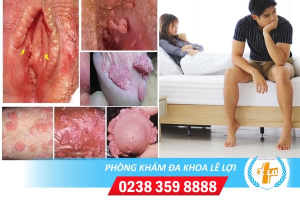Thời gian chữa sùi mào gà bao lâu?