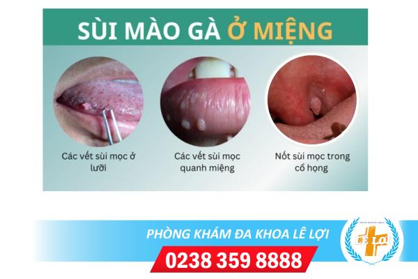 Triệu chứng sùi mào gà miệng, cần đi khám chữa ngay