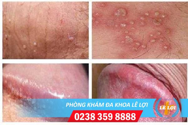 Mụn trắng nhỏ ở dương vật: Dấu hiệu bệnh nguy hiểm