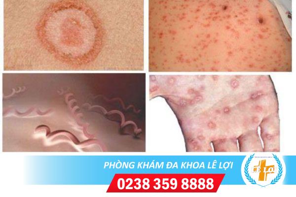 Nơi khám bệnh giang mai nhanh chóng, điều trị hiệu quả