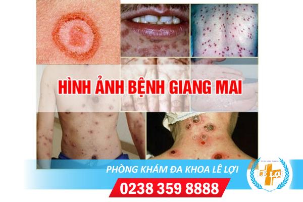 Bệnh viện khám chữa bệnh giang mai tốt hiện nay