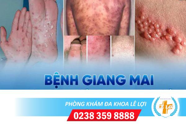 Phòng khám bệnh giang mai uy tín, chi phí hợp lý